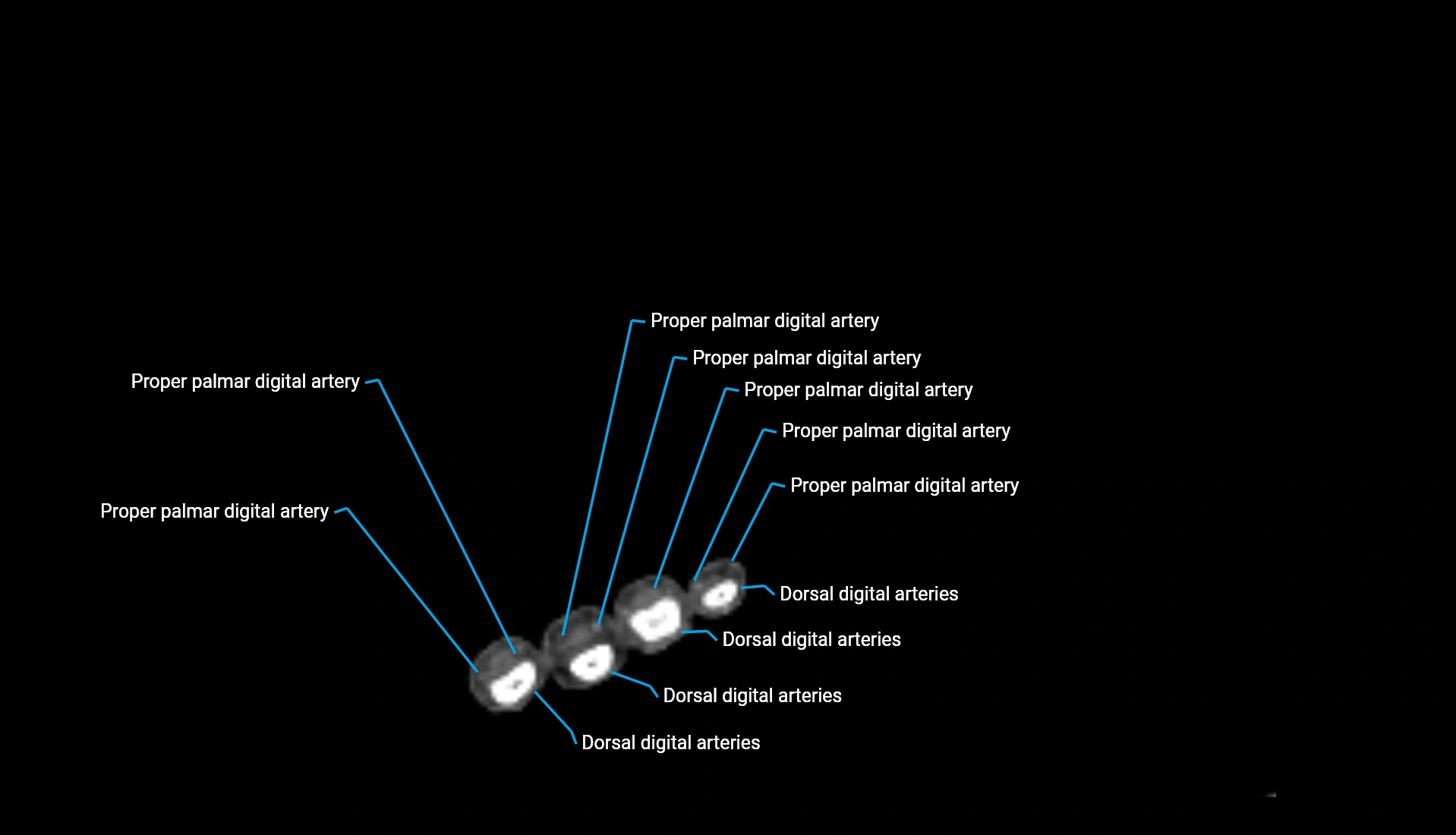 CTA upper limb axial cross sectional anatomy labelled image 28 (3).webp